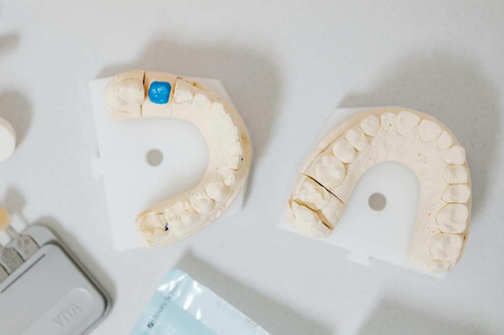 Modelos de escayola de las arcadas dentales para fabricar una férula de descarga a medida